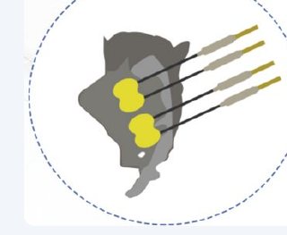 Neurosurgery electrode placement