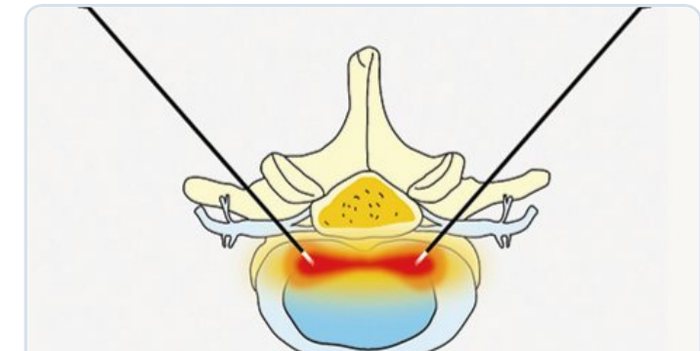 Bilateral pair radiofrequency lesioning