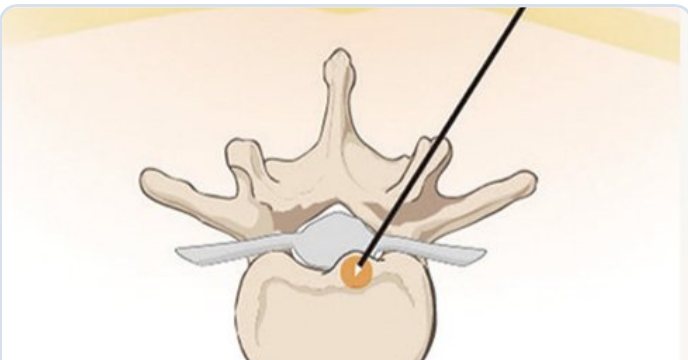 Single target radiofrequency lesioning