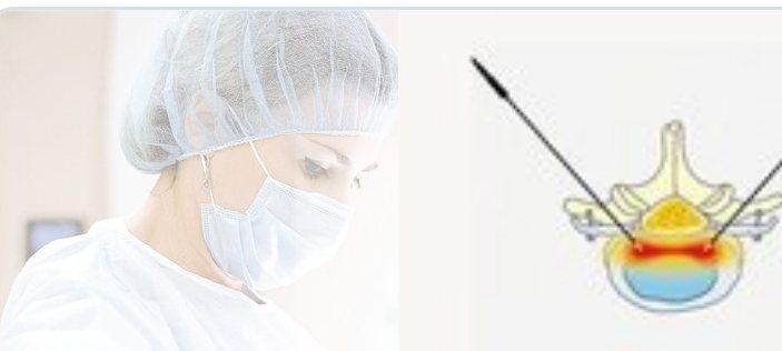 Interventional pain management and neurosurgical lesioning