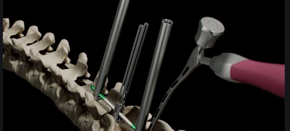 Minimally invasive spine instrumentation